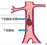下腔静脉滤器置入示意图